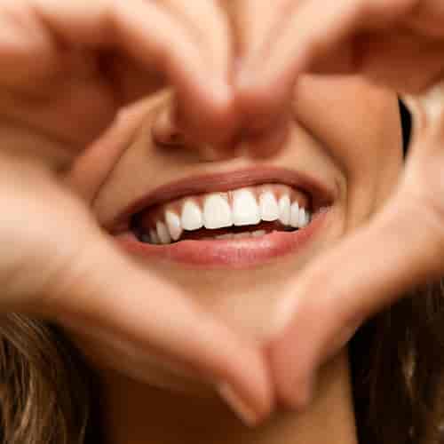 Veneer Smile Makeover 12 Units Los Algodones Baja California 
