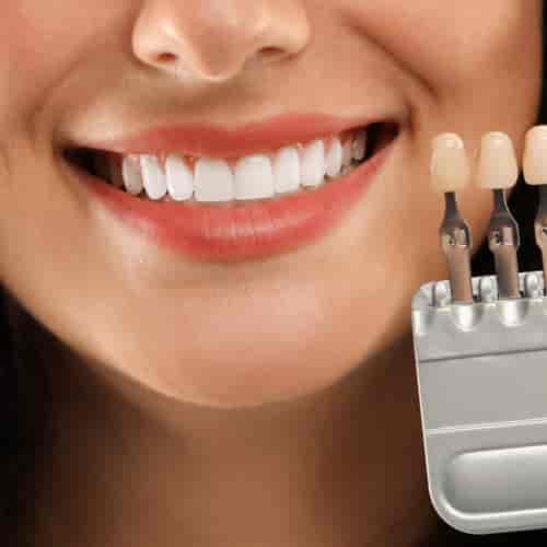 Smile makeover in Istanbul - Hollywood smile, implants, crowns in Istanbul