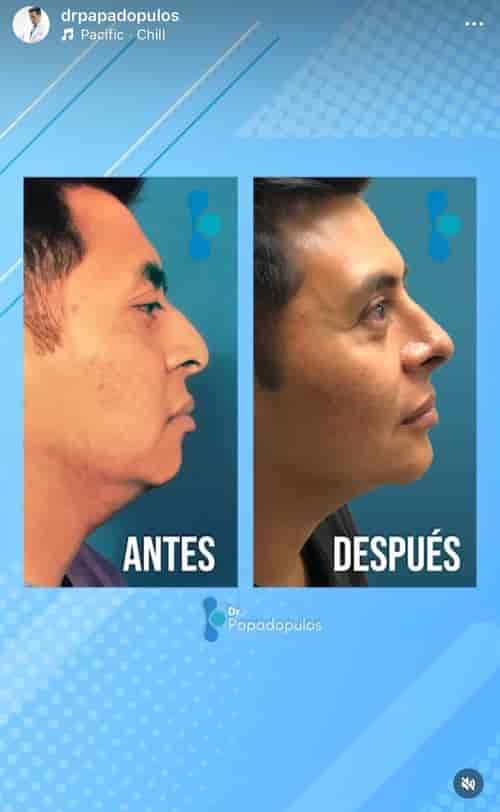 Nose Package at Dr. Ary Papadopulos - Plastic Surgery in Mexico City, Mexico City, Mexico