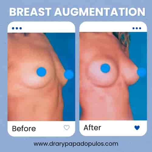 Breast Augmentation Mexico City – Affordable Package with Dr. Ary Papadopulos