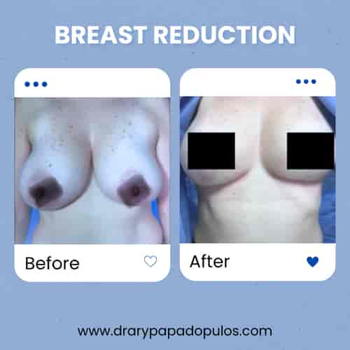 Breast Reduction Package at Dr. Ary Papadopulos - Plastic Surgery in Mexico City, Mexico City, Mexico