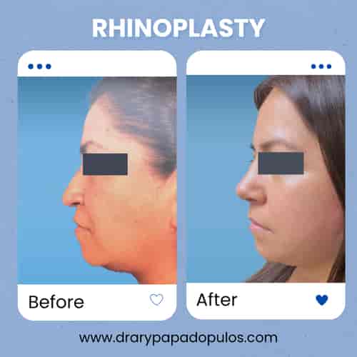Nose Package at Dr. Ary Papadopulos - Plastic Surgery in Mexico City, Mexico City, Mexico