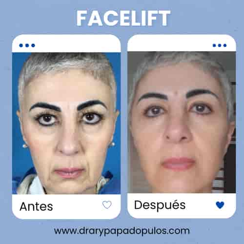 Premium Facelift Mexico Package at $12,500 by Dr. Papadopulos