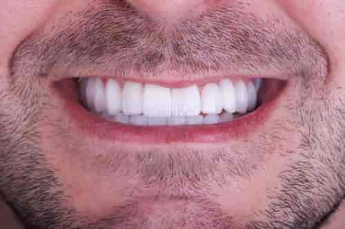 All on 4 Dental Implants Package at DentSpa