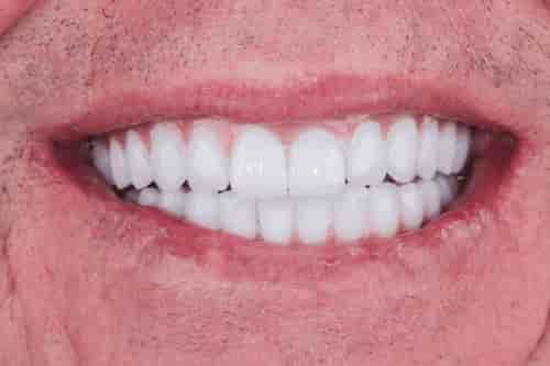 ALL-ON-6 DENTAL IMPLANTS + CROWNS 
