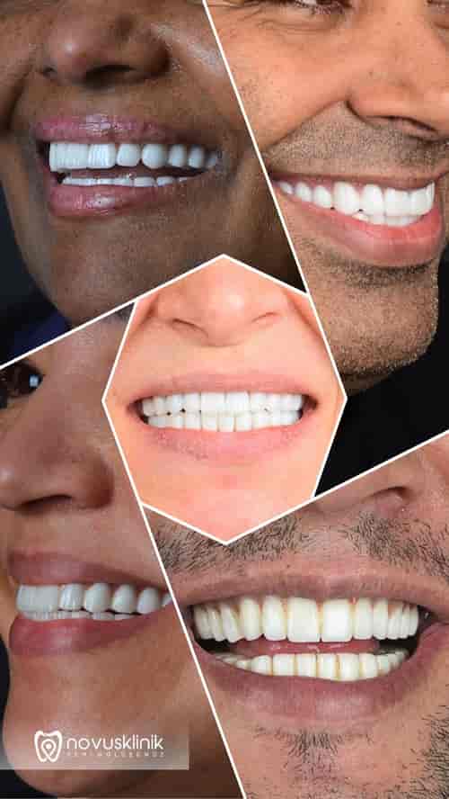 14 X ZIRCONIA CROWNS SMILE DESIGN PACK
