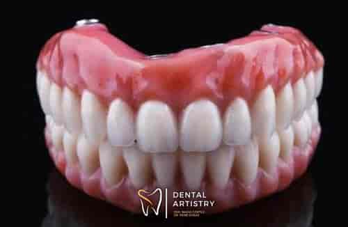 All-Inclusive All-on-6 Dental Implants Package in Nuevo Progreso, Mexico by Dental Artistry