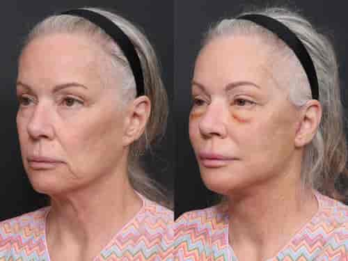 Revision Deep Plane Facelift with Expert Surgeon by Dr. Minhee Ryu at RNWOOD