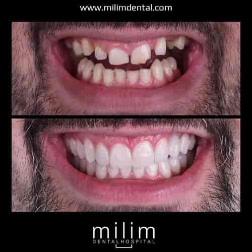 Full Mouth - Essential