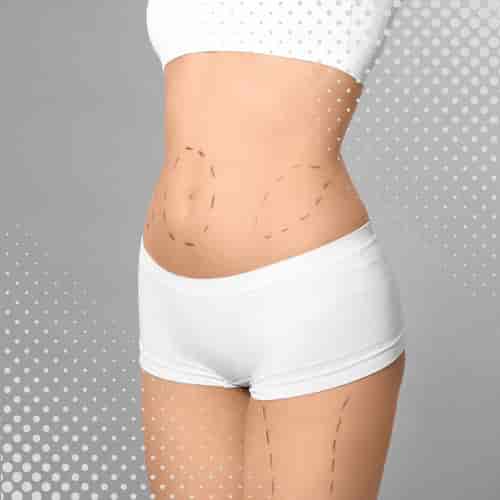 Vaser Liposuction Package in Athens, Greece by Dr. Elias Moustakis