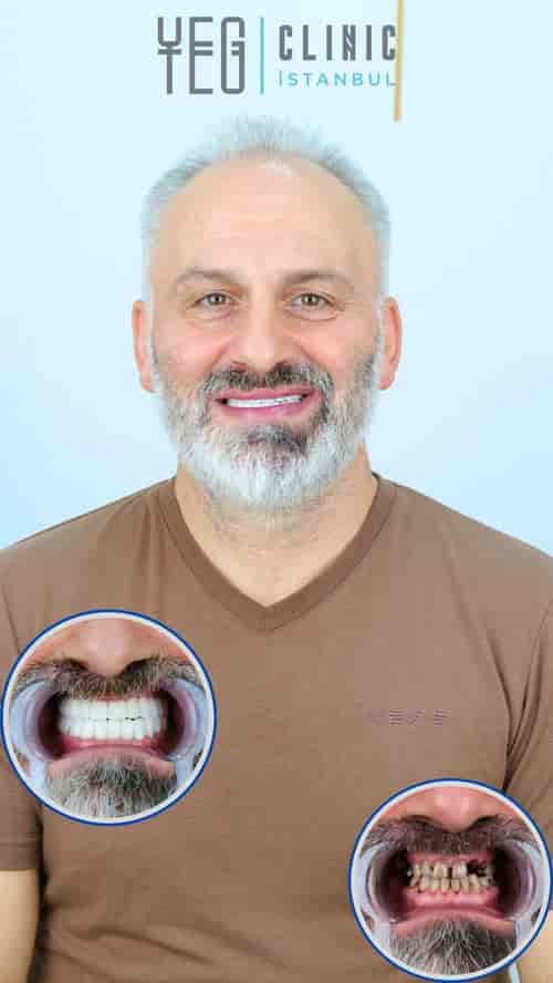 Full Mouth Restoration Package at YEG Clinic - Best Dental Clinic Istanbul, İstanbul, Turkey