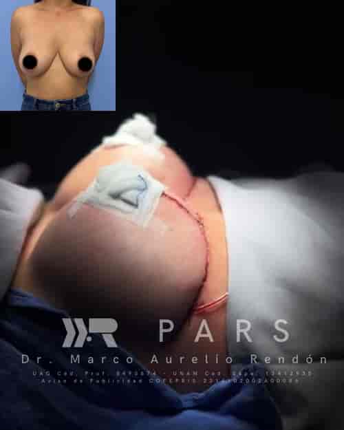 Breast Lift Package at PARS - Plastic, Aesthetic & Reconstructive Surgery in Guadalajara, Mexico, Guadalajara, Mexico