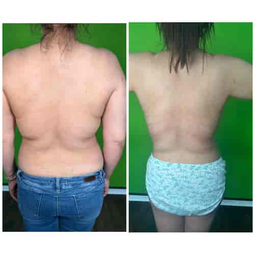 Liposuction Package at Prof. Dr. Furkan Karabekmez Clinic | Best Plastic Surgery Ankara, ankara, Turkey