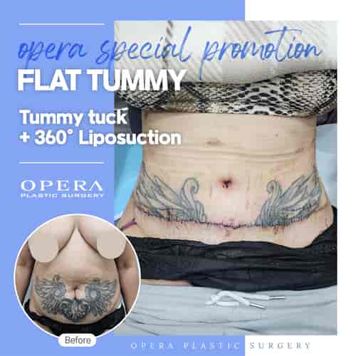 Abdominoplasty Package at Opera Plastic Surgery in Gangnam, South Korea, Seoul, South Korea