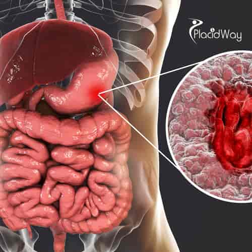 Gastric Sleeve Package by Prof. MD. Umit Koc in Turkey