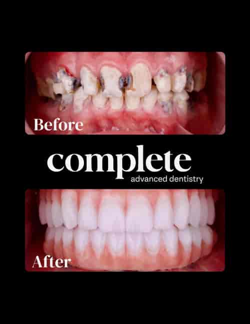 All on 4 Dental Implants VIP Package at Complete Advanced Dentistry - Dental Clinic in Los Algodones