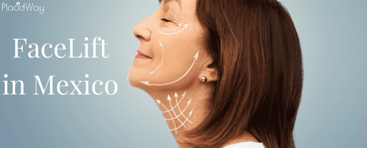 Lifting facial en México: recupere su apariencia juvenil