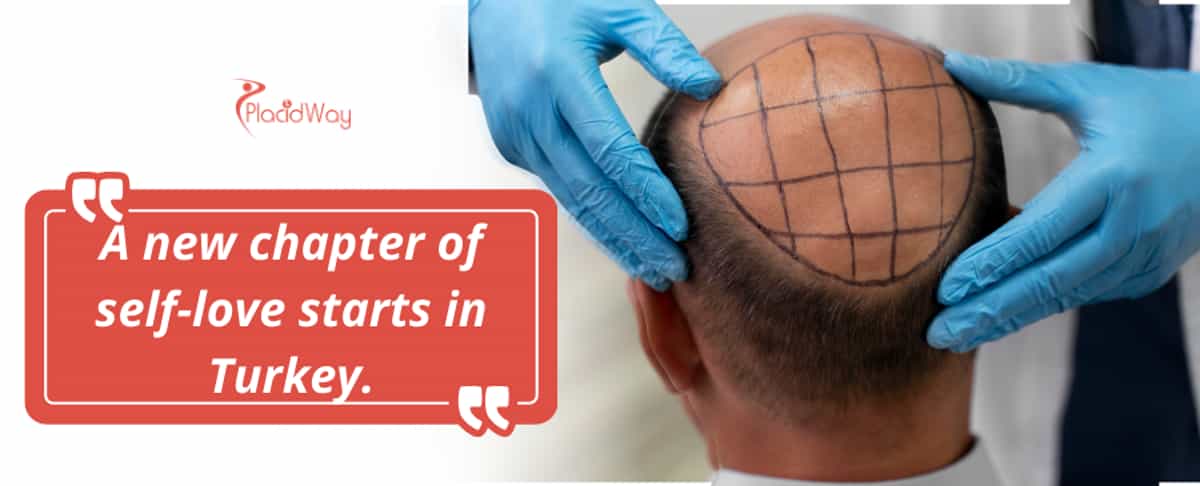 زراعة الشعر في تركيا