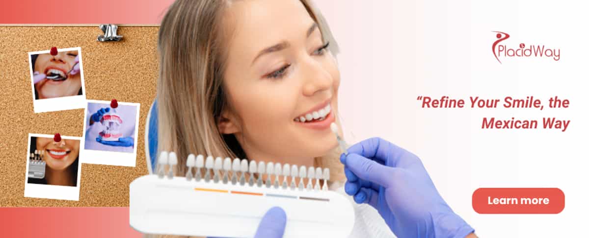 Dental Veneers in Puerto Vallarta Mexico