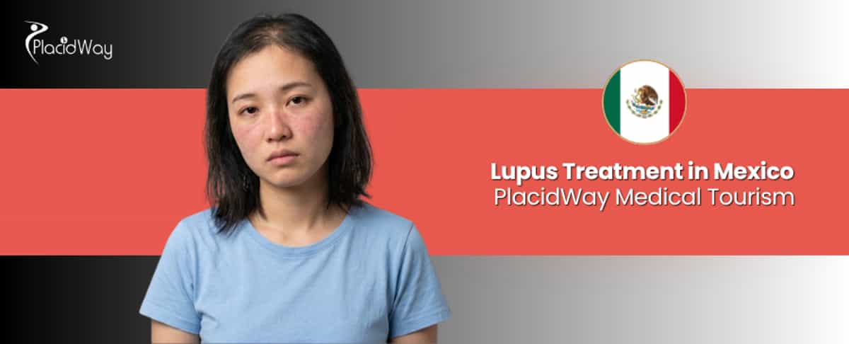 Tratamiento del lupus en México
