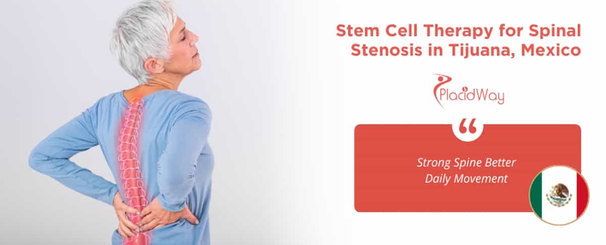 Stem Cell Therapy for Spinal Stenosis in Tijuana, Mexico