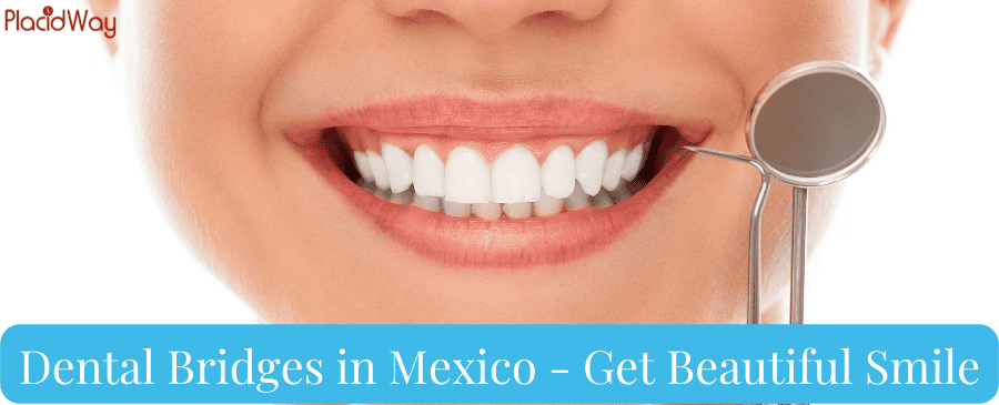 Dental Bridges in Mexico - Get Beautiful Smile thumbnail