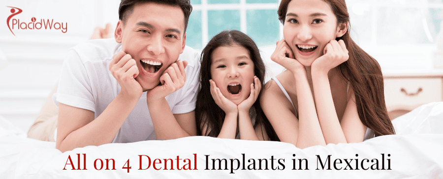 Implantes dentales All on 4 en Mexicali thumbnail
