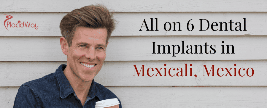Implantes dentales All on 6 en Mexicali México thumbnail