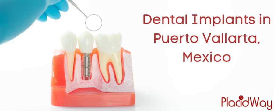 Dental Implants in Puerto Vallarta, Mexico - Low-Cost and Quality