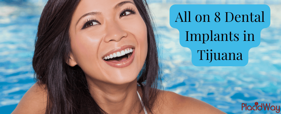 All on 8 Dental Implants in Tijuana - Affordable Dental Work in Mexico