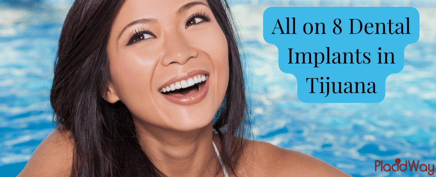 All on 8 Dental Implants in Tijuana - Affordable Dental Work in Mexico