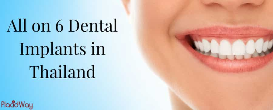 Get Your All on 6 Dental Implants in Thailand