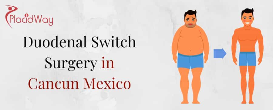 Duodenal Switch Surgery in Cancun, Mexico