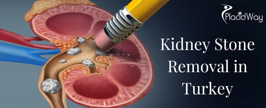 Kidney Stones Removal Surgery in Turkey