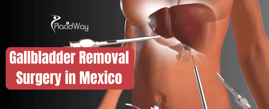 Gallbladder Removal Surgery in Mexico