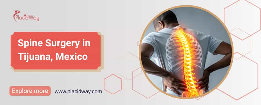 Spine Surgery in Tijuana, Mexico thumbnail