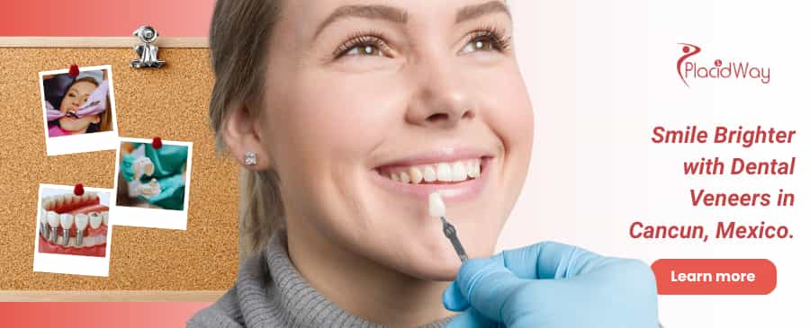 Dental Veneers in Cancun, Mexico thumbnail