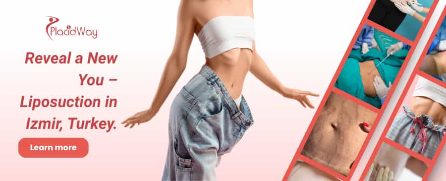 Liposuction in Izmir, Turkey thumbnail