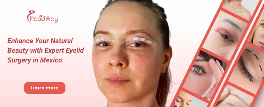 Eyelid Surgery in Mexico City, Mexico thumbnail