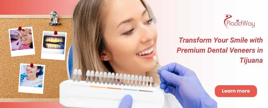 Dental Veneers in Tijuana, Mexico  thumbnail