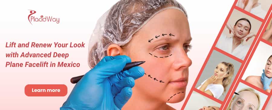 Deep Plane Facelift in Mexico thumbnail