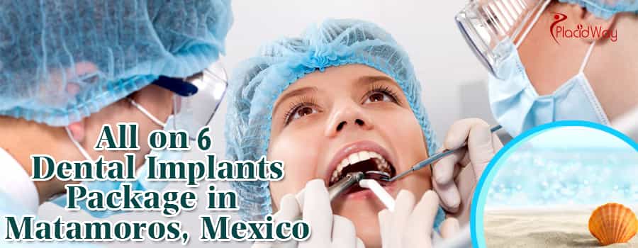 All On Dental Implants Package In Matamoros, Mexico