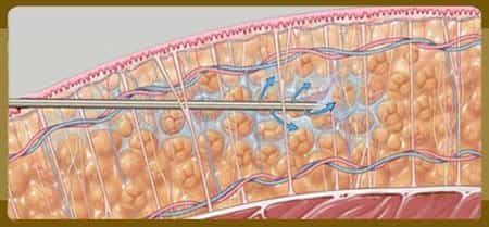Vaser Liposuction procedure