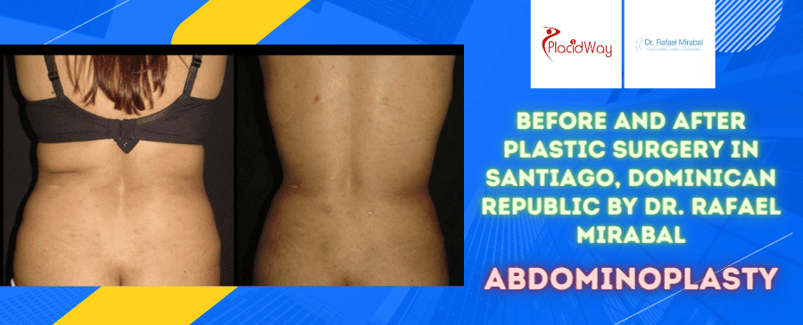 Before and After Abdominoplasty Surgery in Santiago, Dominican Republic