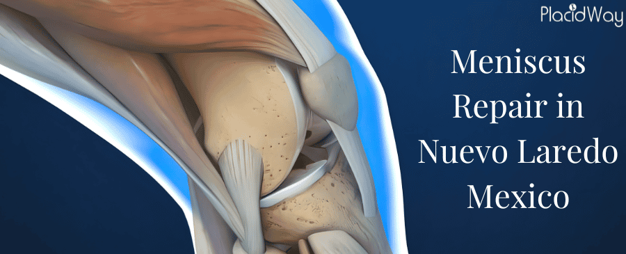 Meniscus Repair in Nuevo Laredo, Mexico Meniscus Repair in Nuevo Laredo, Mexico