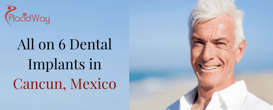 All On Dental Implants In Cancun, Mexico