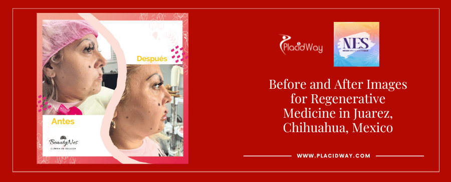 Before and After Images for Regenerative Medicine in Juarez, Mexico