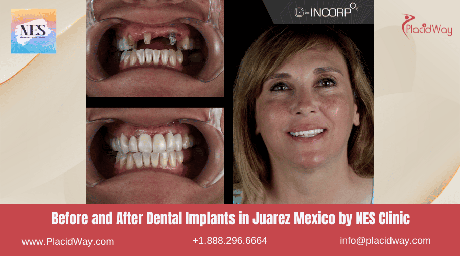 Implantes dentales antes y después en Juárez, México, por la Clínica NES