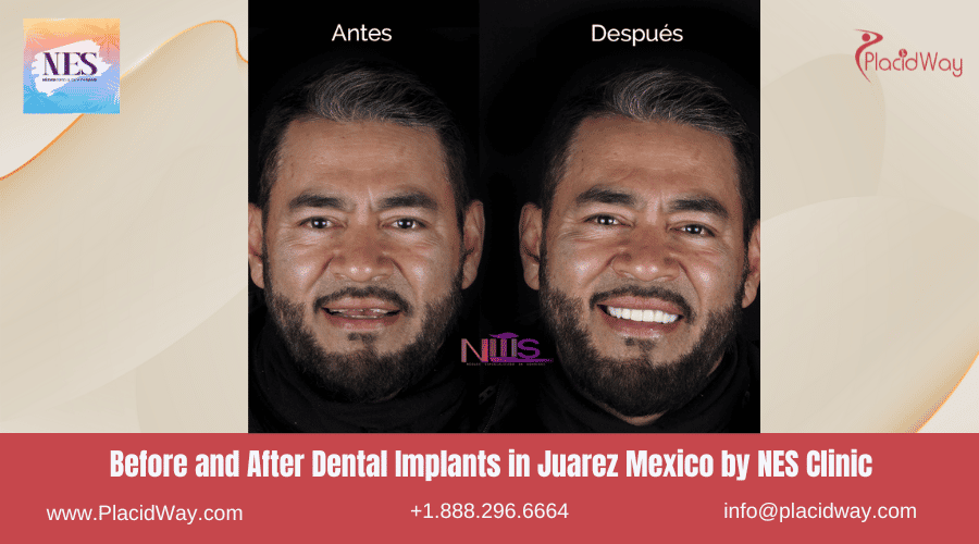 Implantes dentales antes y después en Juárez, México, por NES Dental Clinic
