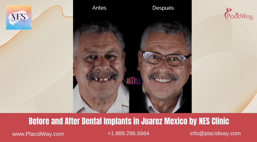 Implantes dentales antes y después en Juárez, México, por la Clínica NES